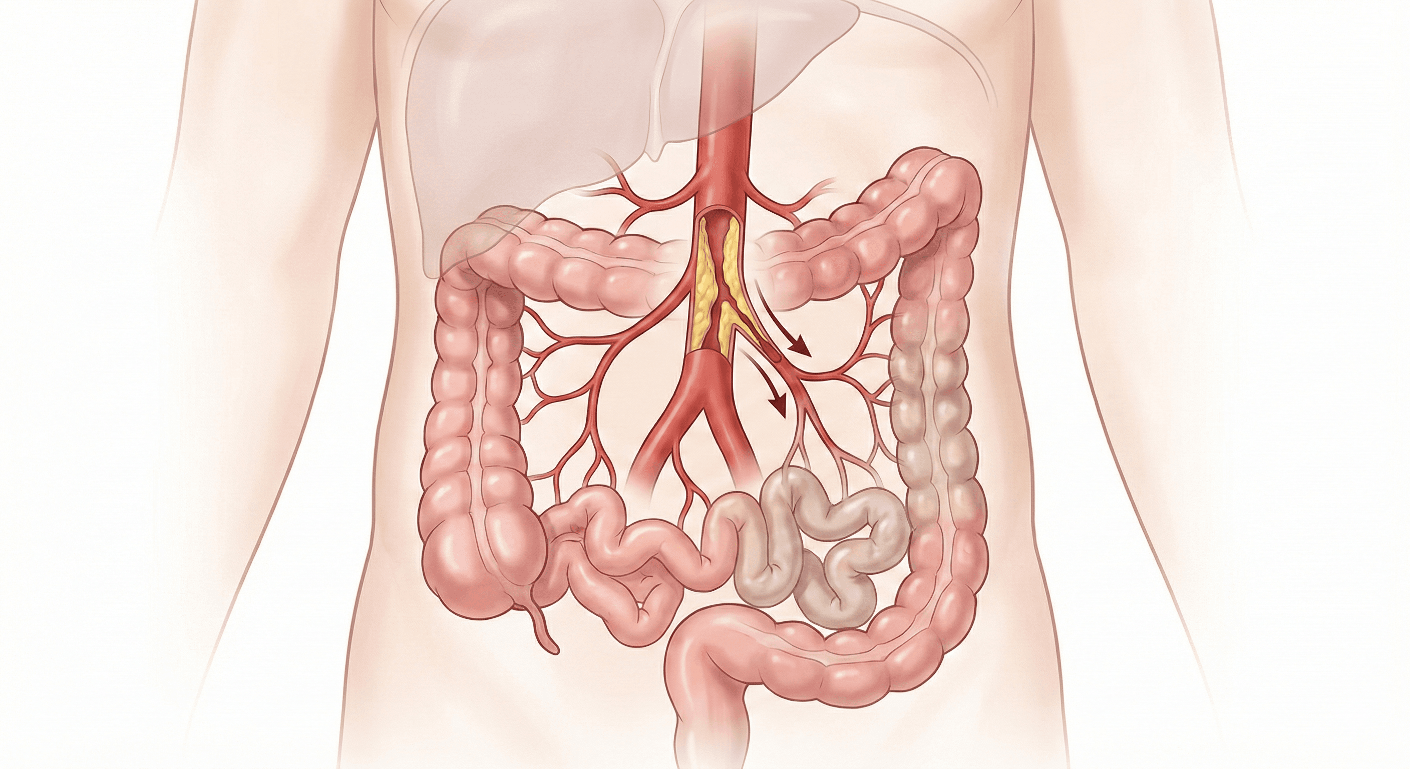 Enfermedad Vascular Mesentérica