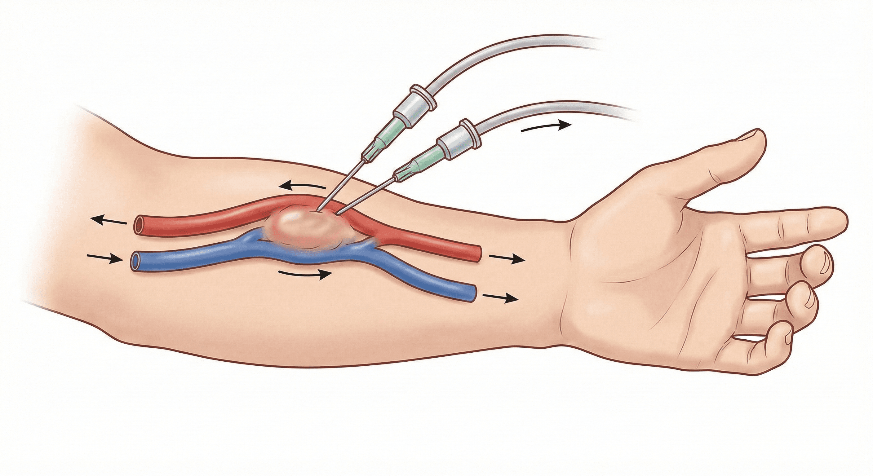 Fístulas Arteriovenosas para Hemodiálisis